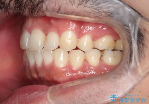 出っ歯の抜歯矯正 裏側ワイヤーによる目立たない矯正の治療後