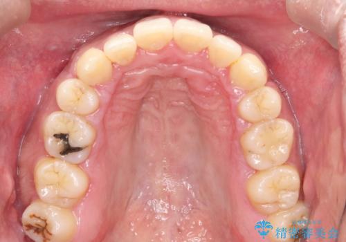出っ歯の抜歯矯正　裏側ワイヤーによる目立たない矯正の治療後