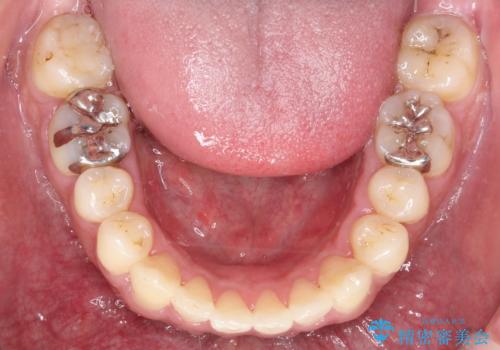 出っ歯の抜歯矯正 裏側ワイヤーによる目立たない矯正の治療後