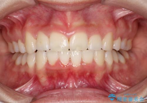 前歯のがたつき・出っ歯 ワイヤーによる抜歯矯正の治療後