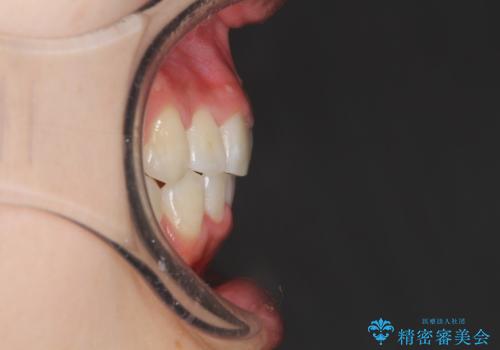 前歯のがたつき・出っ歯 ワイヤーによる抜歯矯正の治療後