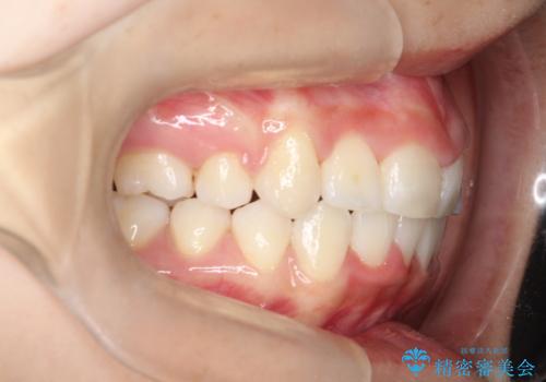 前歯のがたつき・出っ歯 ワイヤーによる抜歯矯正の症例 治療後