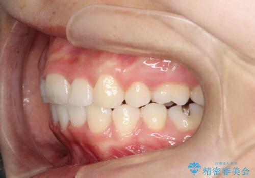 前歯のがたつき・出っ歯　ワイヤーによる抜歯矯正の治療後