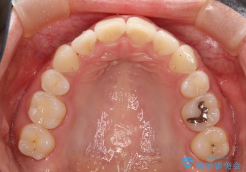 前歯のがたつき・出っ歯 ワイヤーによる抜歯矯正の治療後