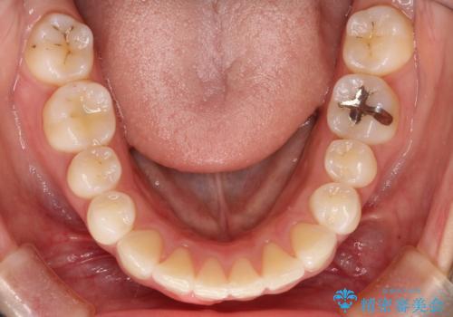 前歯のがたつき・出っ歯 ワイヤーによる抜歯矯正の治療後