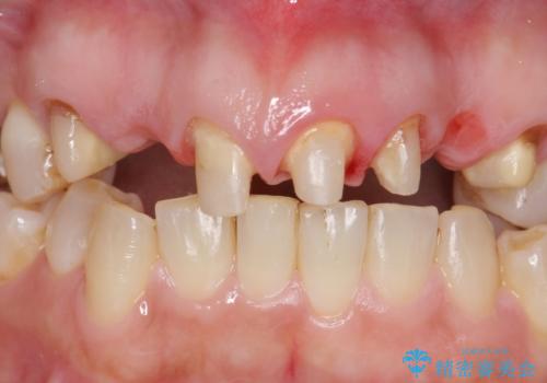 オールセラミッククラウン 前歯の被せ物を綺麗にの治療中