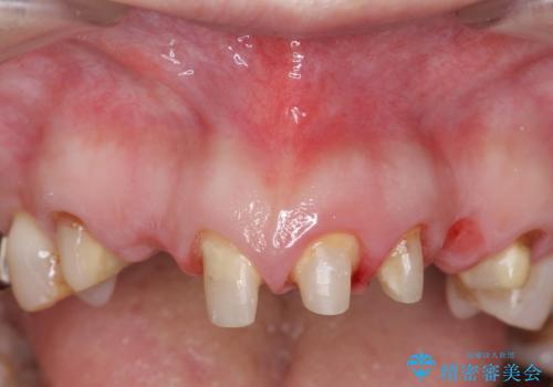 オールセラミッククラウン 前歯の被せ物を綺麗にの治療中