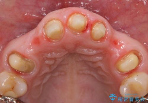 オールセラミッククラウン 前歯の被せ物を綺麗にの治療中