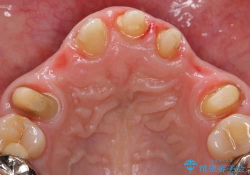 オールセラミッククラウン 前歯の被せ物を綺麗にの治療中