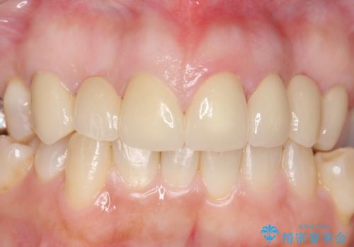 オールセラミッククラウン 前歯の被せ物を綺麗にの治療後