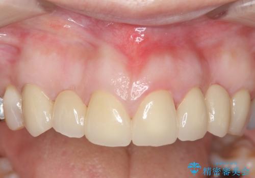 オールセラミッククラウン 前歯の被せ物を綺麗にの治療後