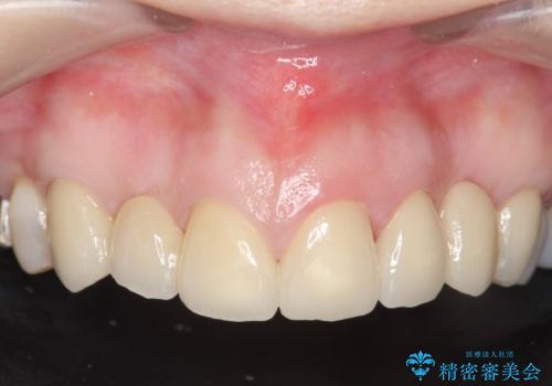 オールセラミッククラウン 前歯の被せ物を綺麗にの治療後