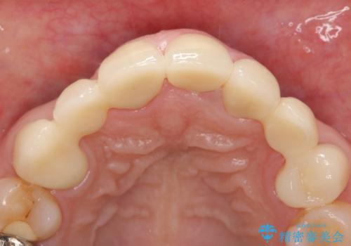 オールセラミッククラウン 前歯の被せ物を綺麗にの治療後