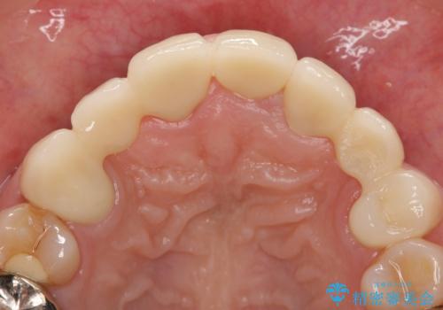 オールセラミッククラウン 前歯の被せ物を綺麗にの治療後