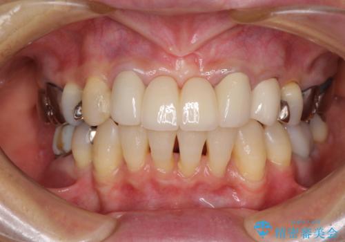 話しにくく腫れやすい前歯のブリッジ　使用感の良いオールセラミックブリッジにの治療後