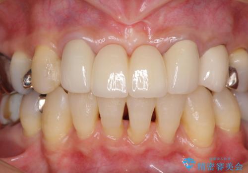 話しにくく腫れやすい前歯のブリッジ 使用感の良いオールセラミックブリッジにの治療後