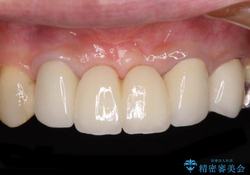 話しにくく腫れやすい前歯のブリッジ 使用感の良いオールセラミックブリッジにの症例 治療後