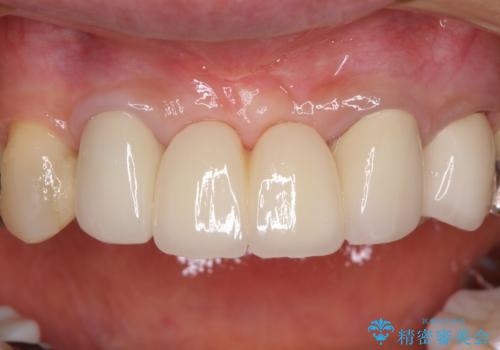 話しにくく腫れやすい前歯のブリッジ 使用感の良いオールセラミックブリッジにの治療後