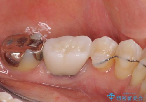 話しにくく腫れやすい前歯のブリッジ 使用感の良いオールセラミックブリッジにの治療後