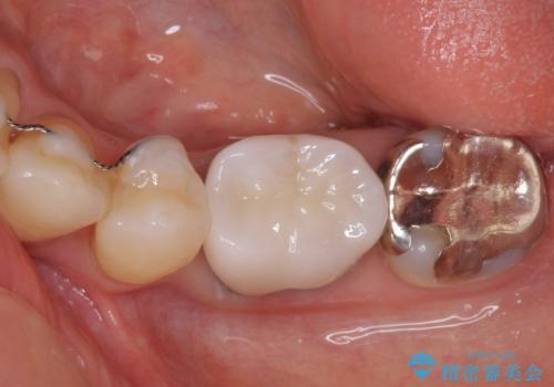 話しにくく腫れやすい前歯のブリッジ 使用感の良いオールセラミックブリッジにの治療後