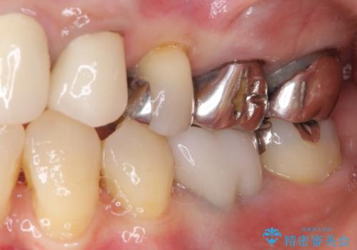 話しにくく腫れやすい前歯のブリッジ 使用感の良いオールセラミックブリッジにの治療後