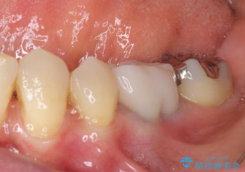 話しにくく腫れやすい前歯のブリッジ 使用感の良いオールセラミックブリッジにの治療後