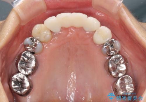 話しにくく腫れやすい前歯のブリッジ 使用感の良いオールセラミックブリッジにの治療後