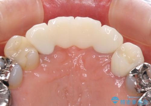 話しにくく腫れやすい前歯のブリッジ 使用感の良いオールセラミックブリッジにの治療後