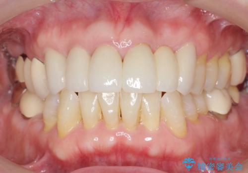 20年前に被せた前歯をやりかえたい 60代女性の治療後