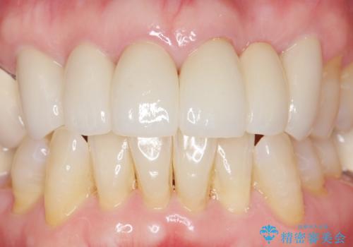 20年前に被せた前歯をやりかえたい 60代女性の治療後