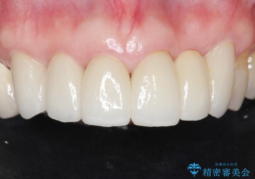 20年前に被せた前歯をやりかえたい 60代女性の治療後