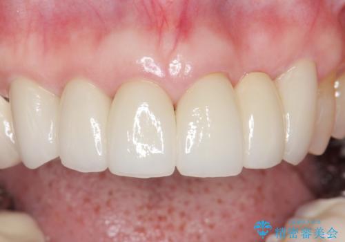 20年前に被せた前歯をやりかえたい 60代女性の治療後