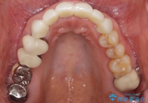 20年前に被せた前歯をやりかえたい 60代女性の治療後