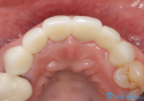 20年前に被せた前歯をやりかえたい 60代女性の治療後