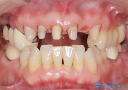 20年前に被せた前歯をやりかえたい 60代女性の治療中