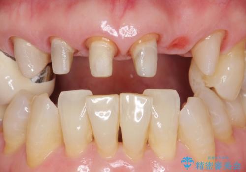 20年前に被せた前歯をやりかえたい 60代女性の治療中