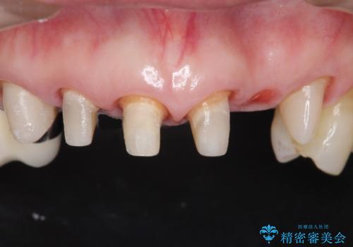 20年前に被せた前歯をやりかえたい 60代女性の治療中