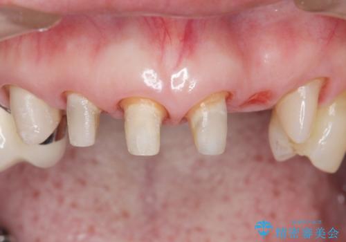 20年前に被せた前歯をやりかえたい 60代女性の治療中