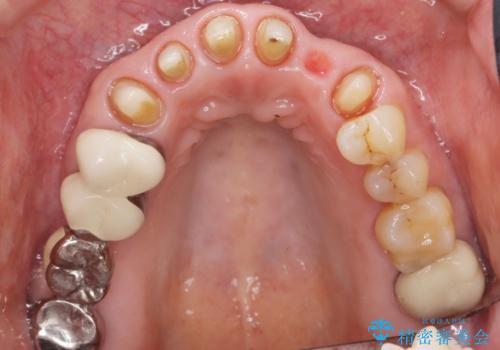 20年前に被せた前歯をやりかえたい 60代女性の治療中