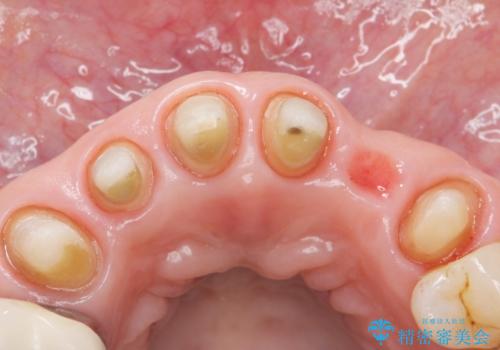 20年前に被せた前歯をやりかえたい 60代女性の治療中