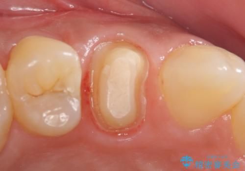 オールセラミッククラウン 歯茎の腫れが引かない歯の治療の治療中