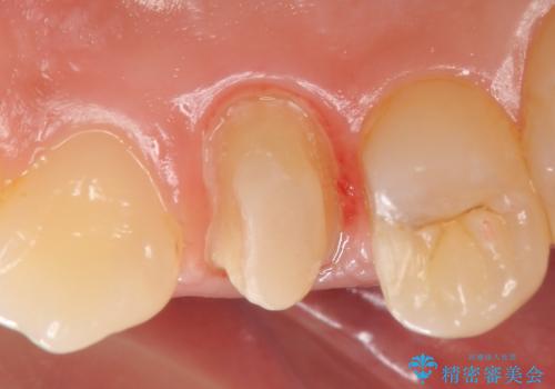 オールセラミッククラウン　歯茎の腫れが引かない歯の治療の治療中