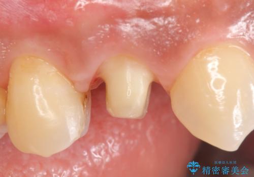 オールセラミッククラウン 歯茎の腫れが引かない歯の治療の治療中