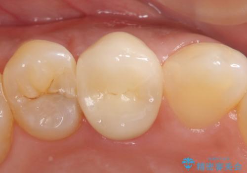 オールセラミッククラウン 歯茎の腫れが引かない歯の治療の治療後