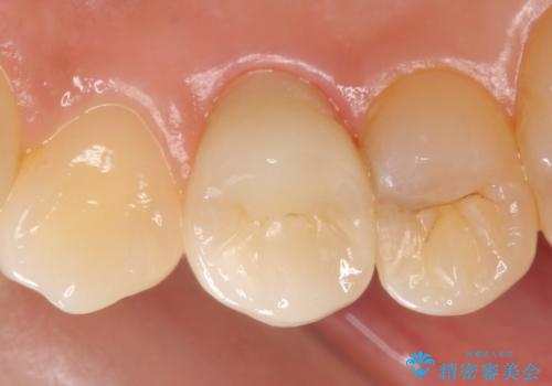 オールセラミッククラウン　歯茎の腫れが引かない歯の治療の治療後