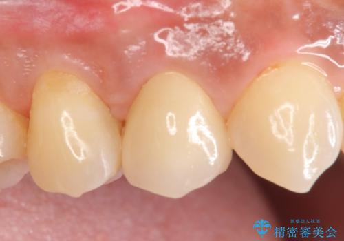 オールセラミッククラウン　歯茎の腫れが引かない歯の治療の治療後