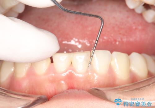 矯正治療を考えている方のクリーニングの治療中