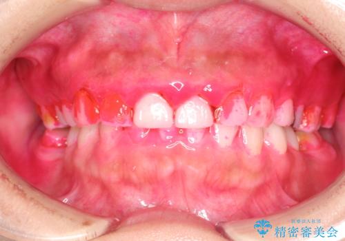 矯正治療を考えている方のクリーニングの治療中