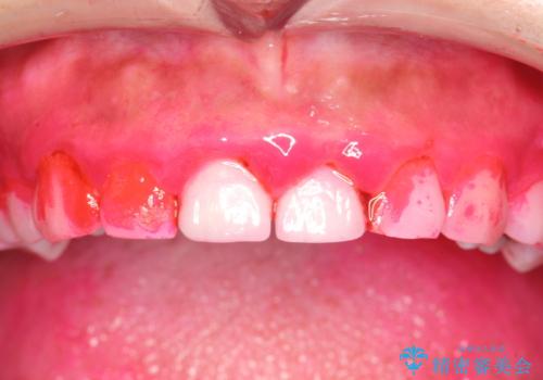 矯正治療を考えている方のクリーニング