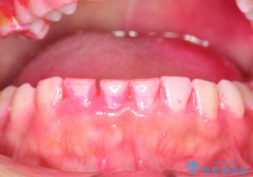 矯正治療を考えている方のクリーニングの治療中